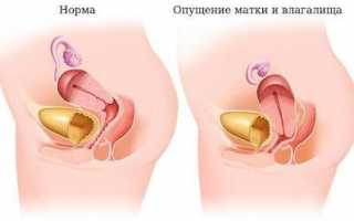 Опущение матки: симптомы и лечение
